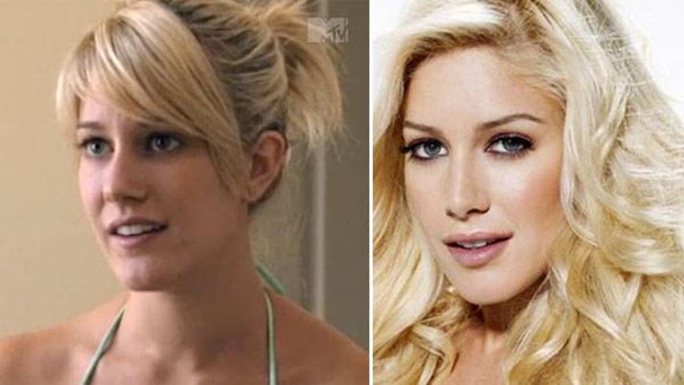 Heidi Montag Before and After