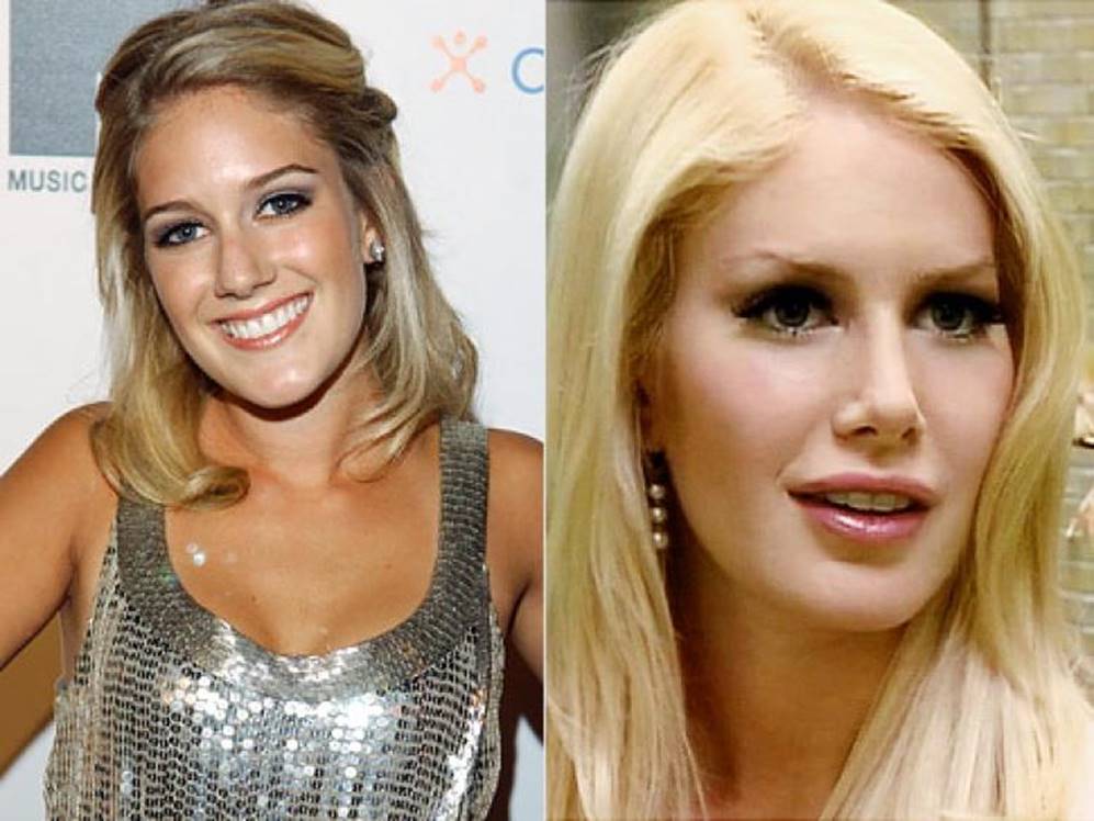 The Ever Changing Look of Heidi Montag’s Before and After